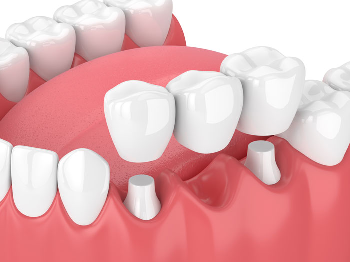 3d Model of a Dental Bridge