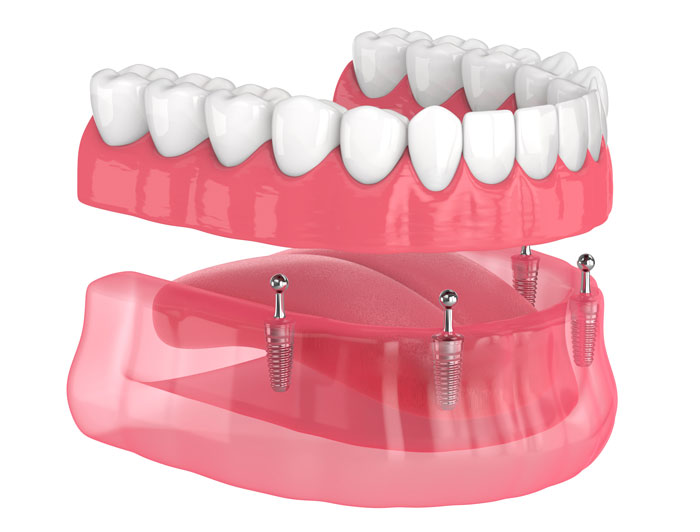 3D Model of a Dentures attached by 4 implants