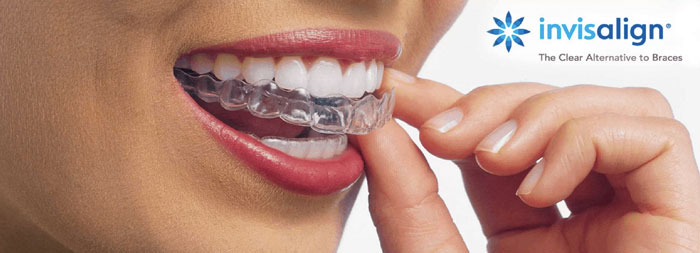 Invisalign. A women putting the clear trays in her mouth