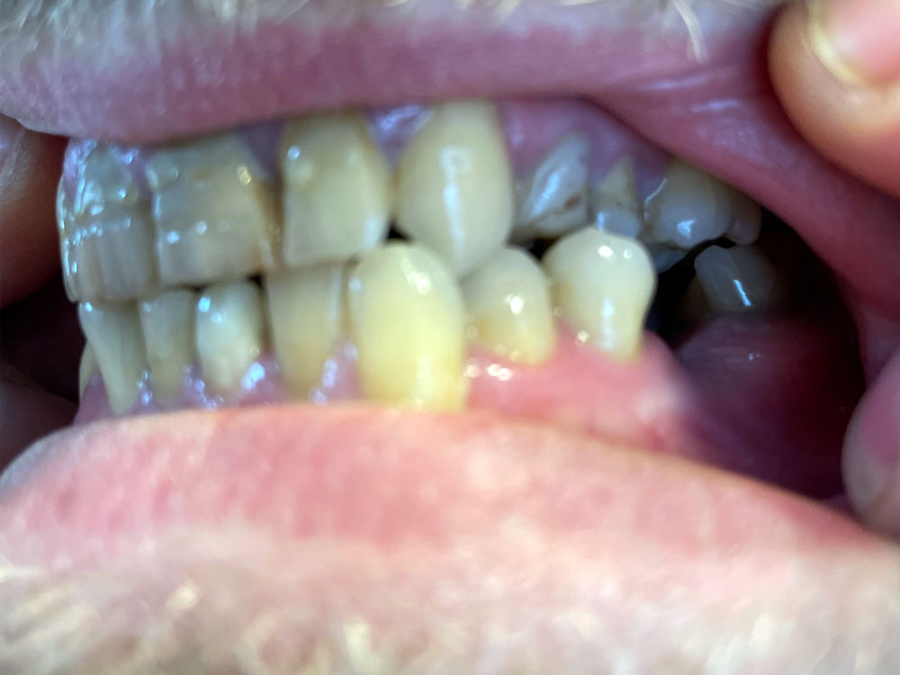 Left Side view of teeth Before